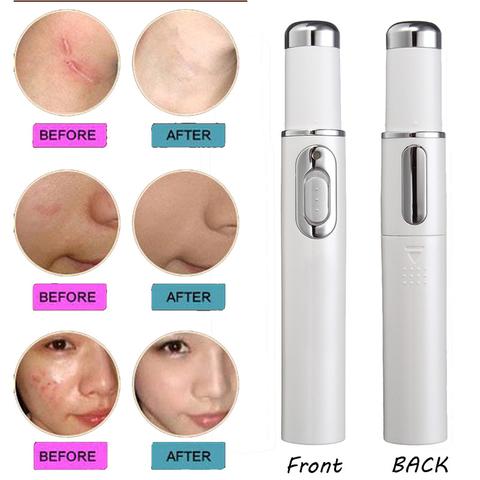 Blue Light Therapy Acne Laser Pen.